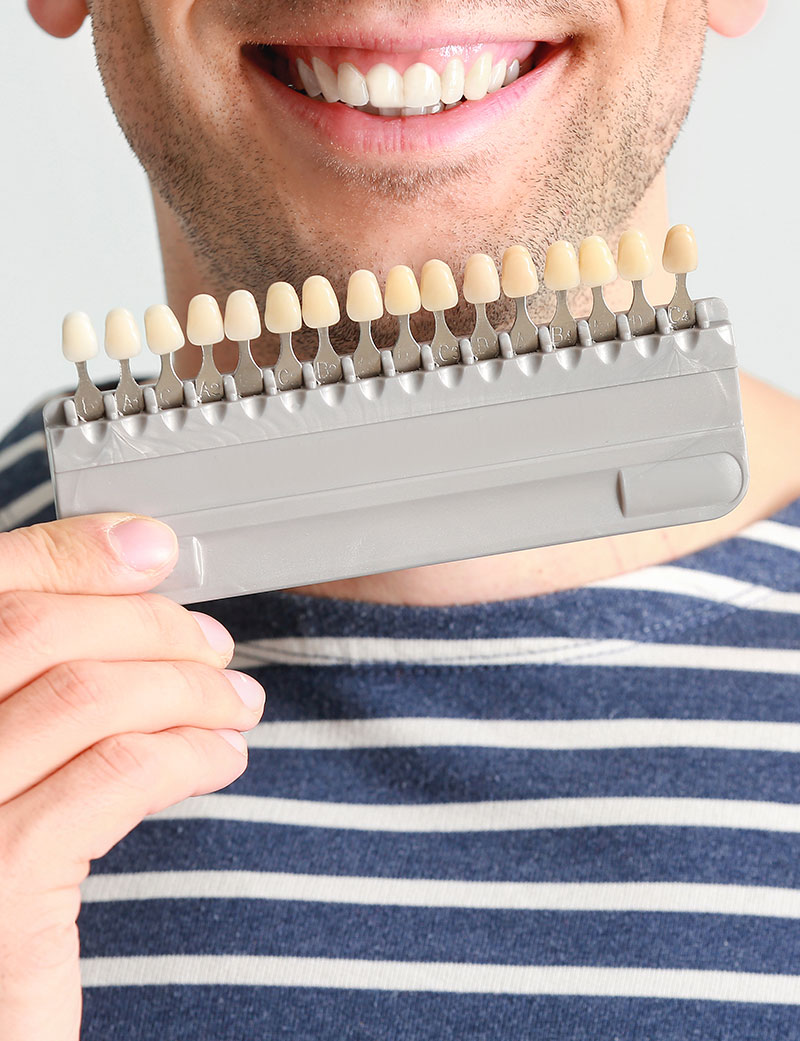 Ragazzo sorride mostrando faccette dentali di vario colore