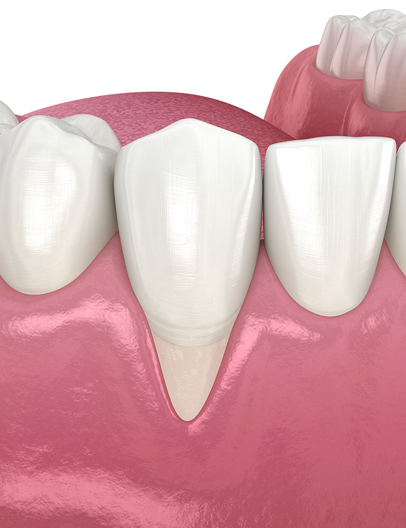 Rendering 3D di un dente affetto da parodontite