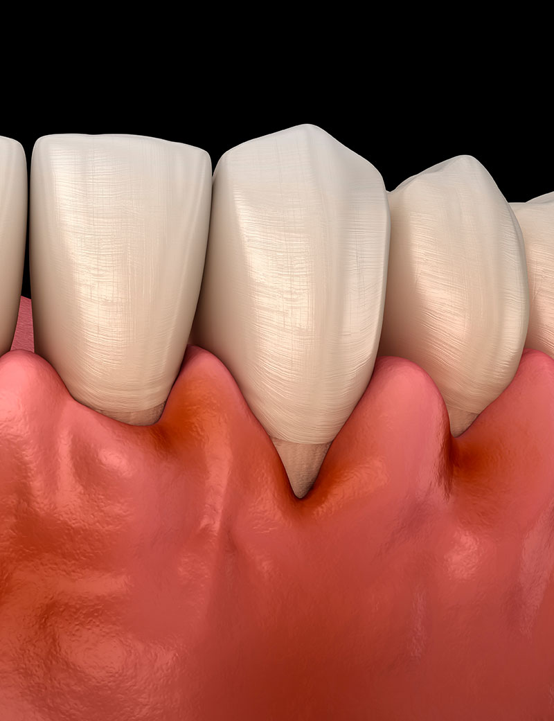 Rendering 3D di denti con gengive ritirate a causa della Parodontite