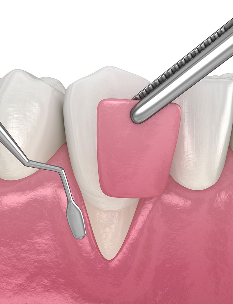 Rendering 3D chirurgia rigenerativa per Parodontite