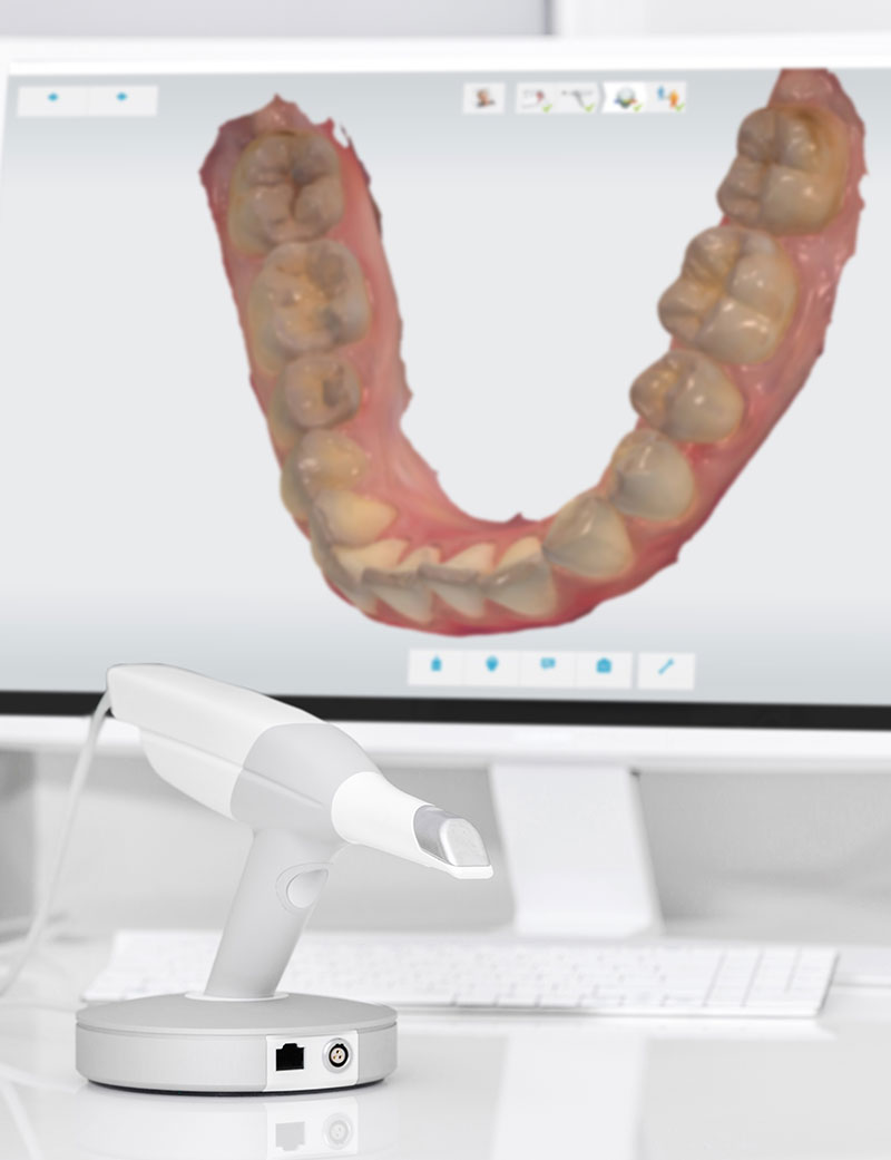 Scansione 3D del sorriso con Scanner Intraorale