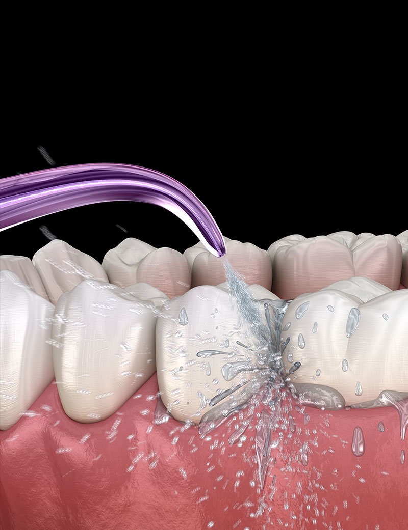 Rendering irrigazione per igiene orale