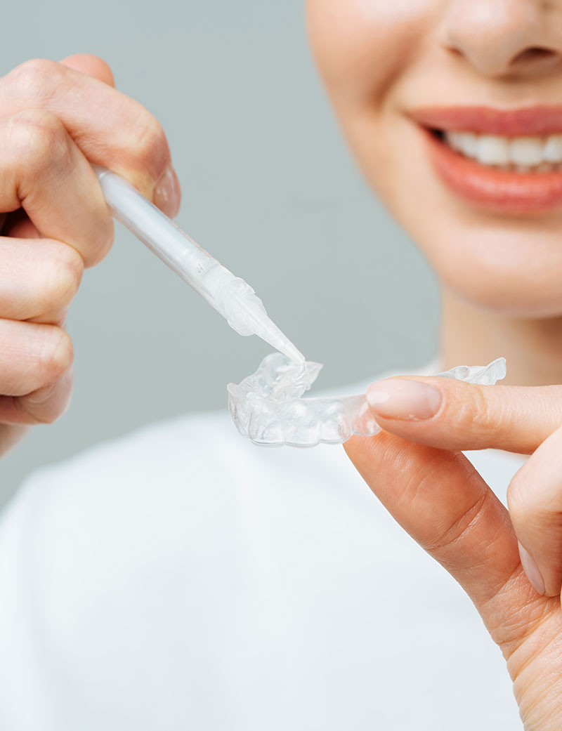 Ragazza che prepara la mascherina per lo sbiancamento dentale domiciliare